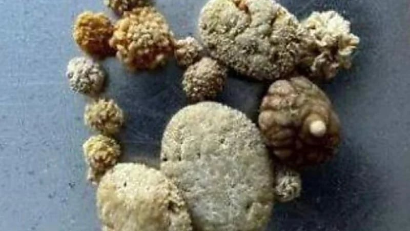 مخرج يعتبر حصوات كليته عملاً فنيًا ويعرضها للبيع