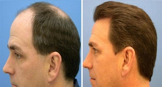 اكتشاف طريقة جديدة لزرع الشعر دون " كيماوي "