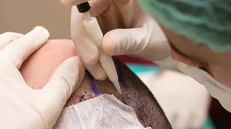 وفاة غامضة لبريطاني قبل عملية زراعة الشعر في تركيا