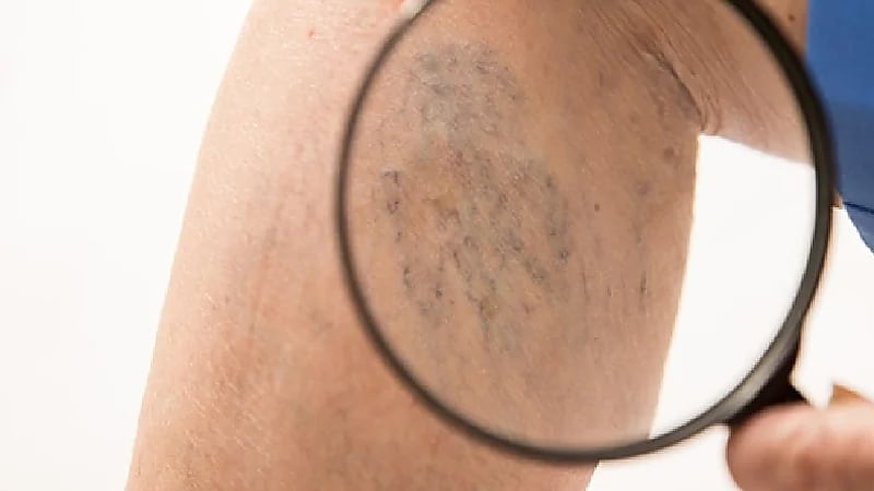 دراسة: دوالي الساقين قد تزيد خطر الإصابة بالخرف