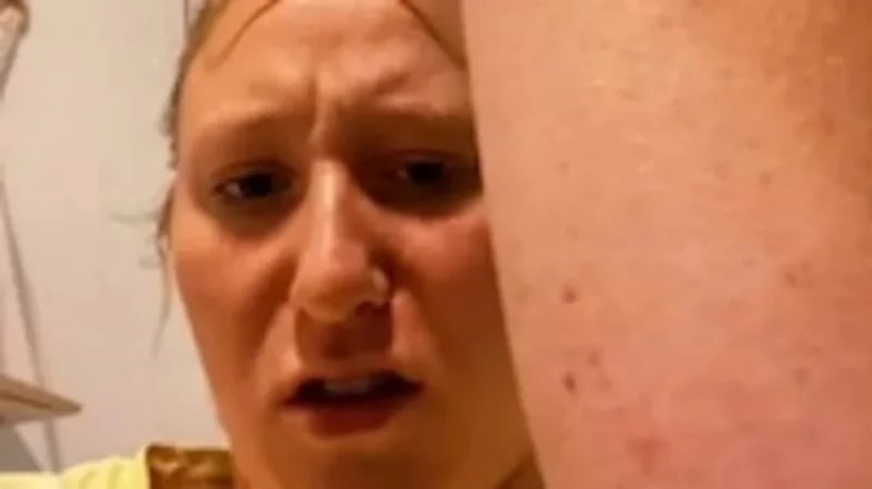 علامات غامضة على جسد امرأة تكشف اصابتها بالسرطان