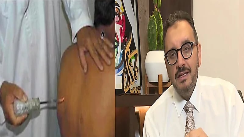 فيديو.. تحذير من مضاعفات كارثية للعلاج بالكي