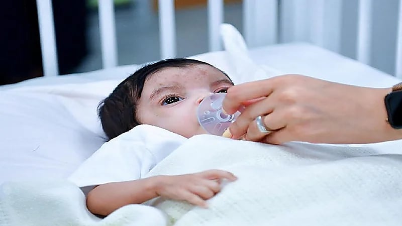 "الربيعة": عملية فصل التوأم الطفيلي اليمني تسير أسرع من الخطة الموضوعة