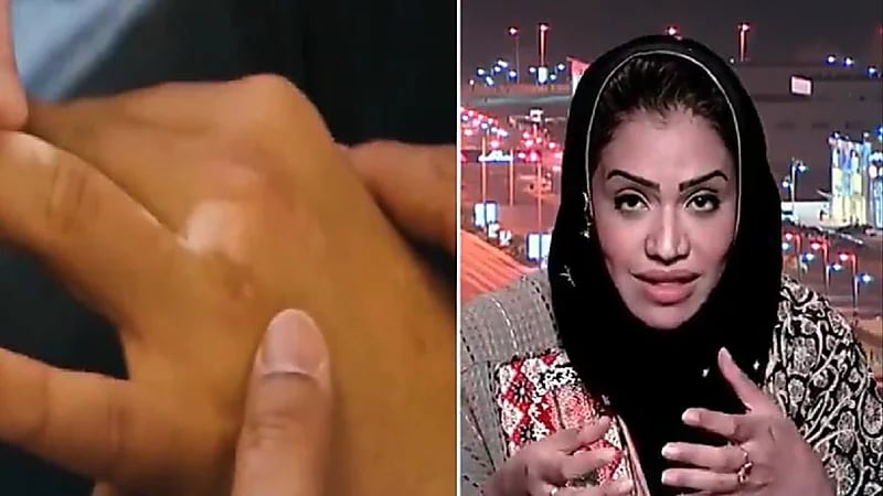 استشارية : المملكة من أفضل دول العالم في علاج البهاق ولدينا علاجات من أيام الفراعنة (فيديو)