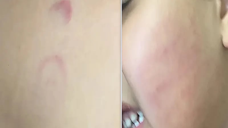 التحقيق في اعتداء اختصاصية على طفل يعاني التوحد بعسير