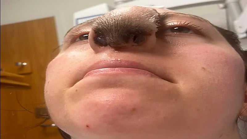 عملية تجميل تحول أنف فتاة لأنف كلب.. صور