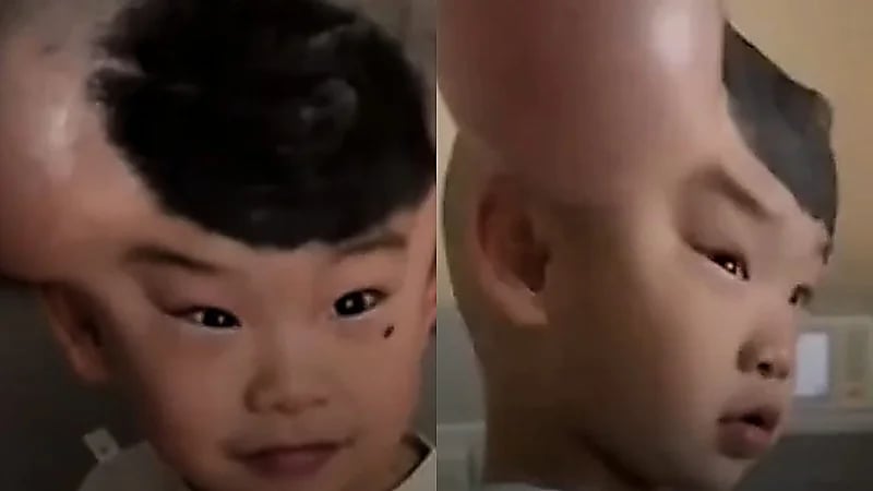 طفل صيني يُلقب بـ ميكي ماوس بسبب وحمتين نادرتين على رأسه .. فيديو