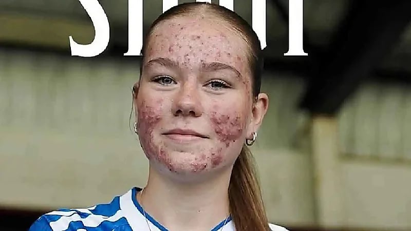 حبوب الشباب تحرم لاعبة شابة من فرحة تقديمها