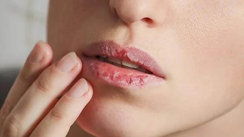 علامات في الشفاه تنبئ بمخاطر صحية محتملة