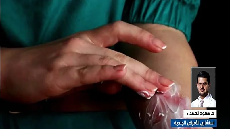 استشاري: استخدام الثلج وقت الحرق يوسع الإصابة ويتسبب بحروق باردة(فيديو)