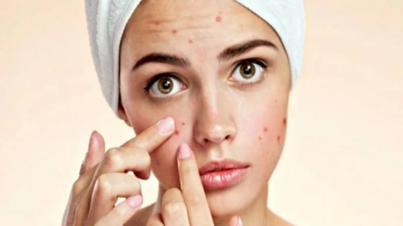 خطوات تساعدك للتخلص من حبوب الوجه قبل الزفاف