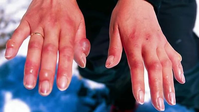 طرق علاج "قضمة الصقيع" في المنزل