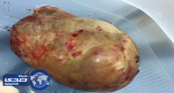 نجاح عملية استئصال ورم حميد بحجم ١١سم لمريضة