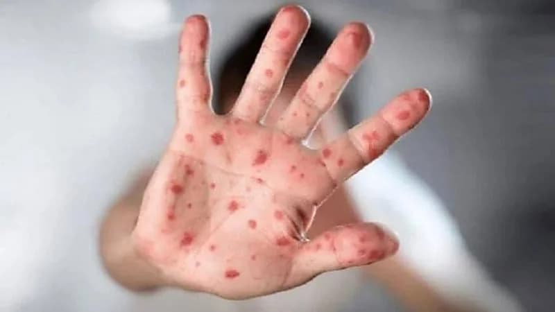 بالفيديو.. استشاري يوضح الفرق بين جدري القردة وجدري الماء