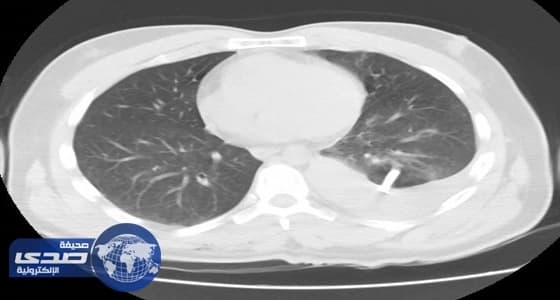 بالصور.. إنقاذ حياة " أربعيني " سقط على طاولة واخترق الزجاج رئته في سكاكا