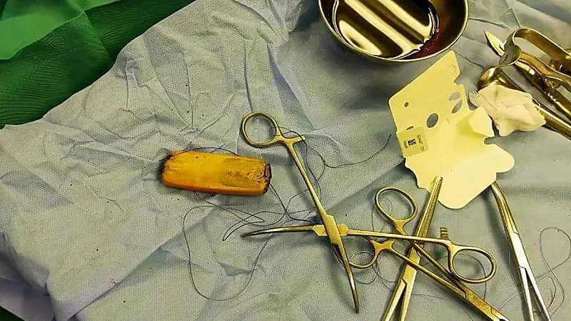 فريق طبي يتفاجأ بشيء غريب في معدة مريض