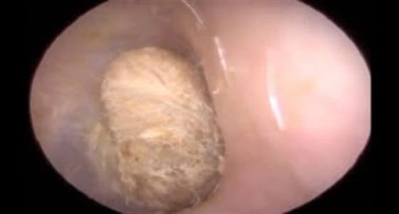 بالفيديو.. إزالة قطنة علقت في أذن رجل لعامين