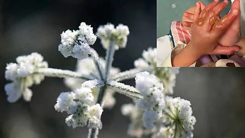 نبتة خطيرة تصيب طفلة بحروق في يدها