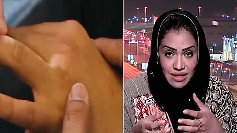 استشارية : المملكة من أفضل دول العالم في علاج البهاق ولدينا علاجات من أيام الفراعنة (فيديو)