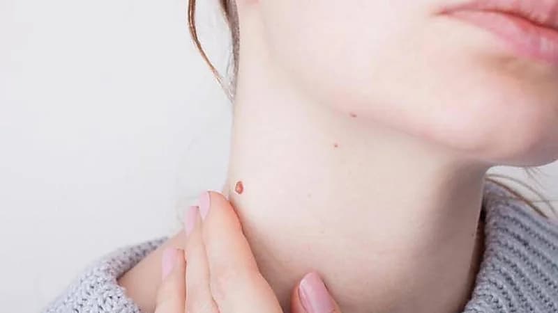 علاجات طبيعية تخلصك من الزوائد الجلدية في المنزل