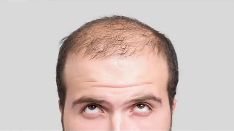 اكتشاف علاج طبيعي لتساقط الشعر دون الحاجة إلى الزراعة