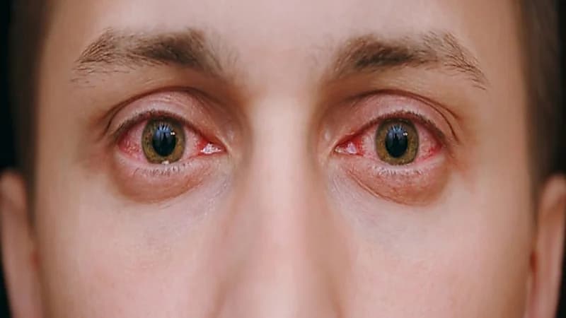 الرمد الربيعي يهاجم العين في فصل الربيع