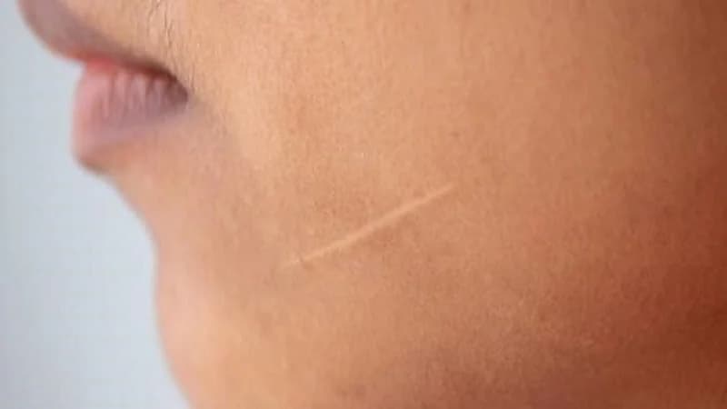 استشاري: شكل الندبة ولونها هو ما يحدد طريقة علاجها .. فيديو