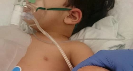 ماء النار ينهش لحم طفل عمره عامين في الأحساء