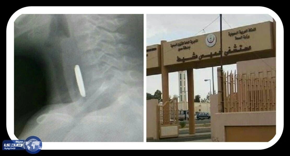 استخراج بطارية ألعاب من مجرى مريء طفل بمستشفى خميس مشيط