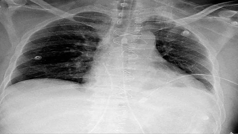 "سعود الطبية" تنقذ مقيمًا تعرض للإصابة في القلب