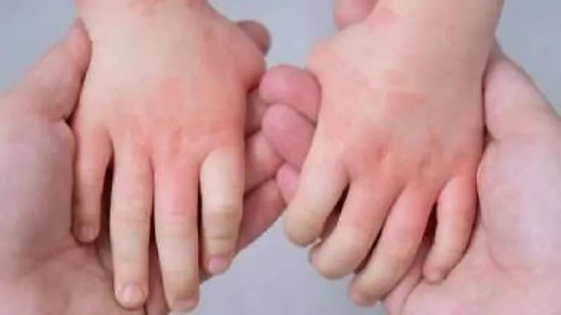 إصابة 26 طفلًا بـ «إنفلونزا الطماطم» في الهند