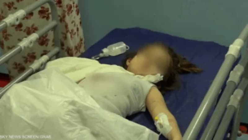 العراق.. دب ينهش ذراع طفلة